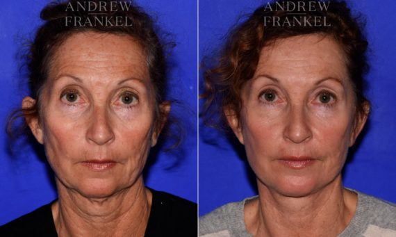 Facelift before and after photos in Beverly Hills, CA, Patient 16768