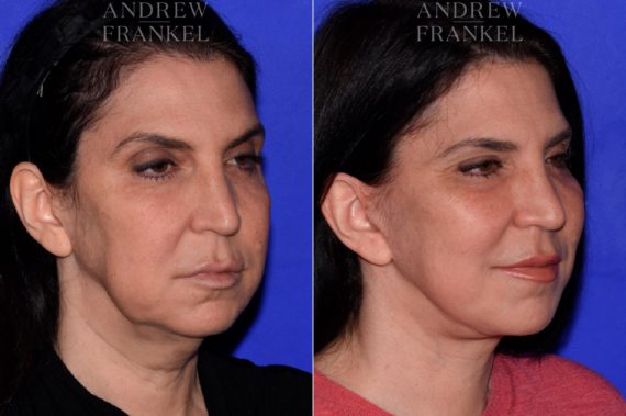 Facelift before and after photos in Beverly Hills, CA, Patient 16802