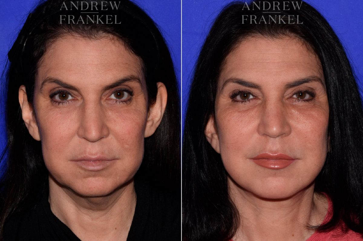 Facelift before and after photos in Beverly Hills, CA, Patient 16802