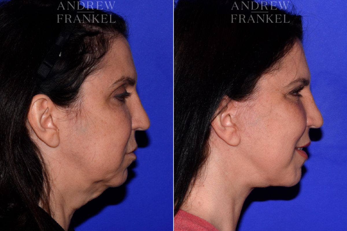 Facelift before and after photos in Beverly Hills, CA, Patient 16802