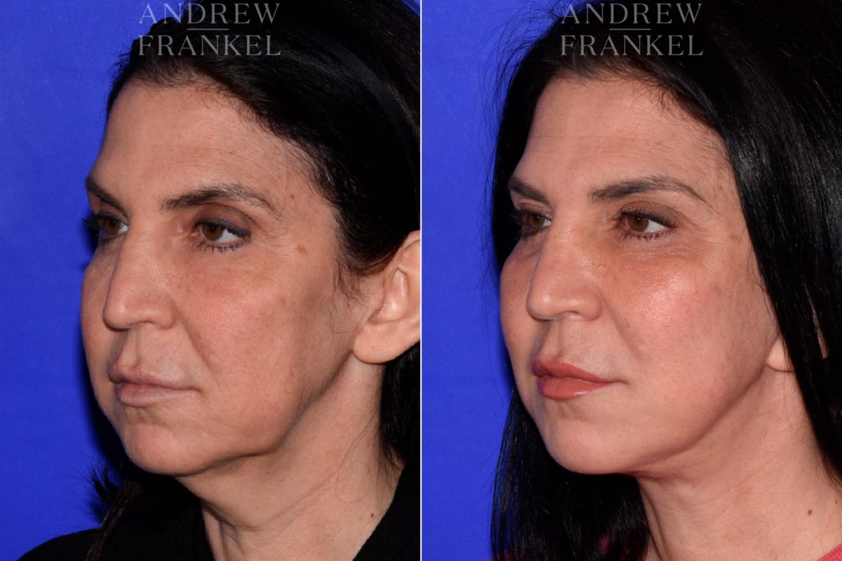 Facelift before and after photos in Beverly Hills, CA, Patient 16802