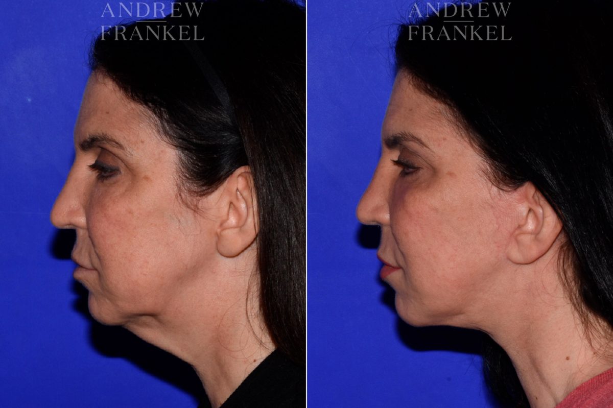 Facelift before and after photos in Beverly Hills, CA, Patient 16802