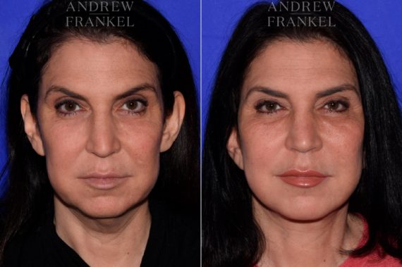 Facelift before and after photos in Beverly Hills, CA, Patient 16802