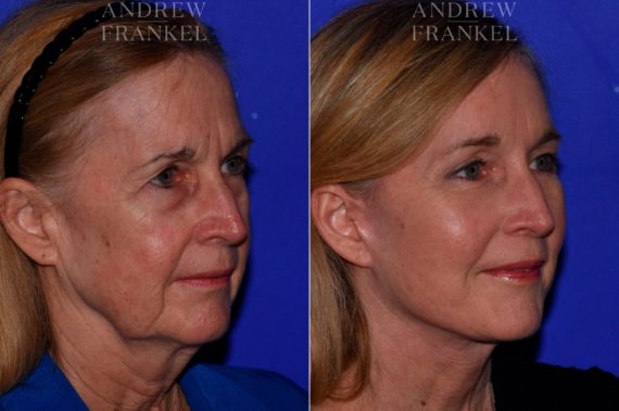 Facial Rejuvenation before and after photos in Beverly Hills, CA, Patient 16836