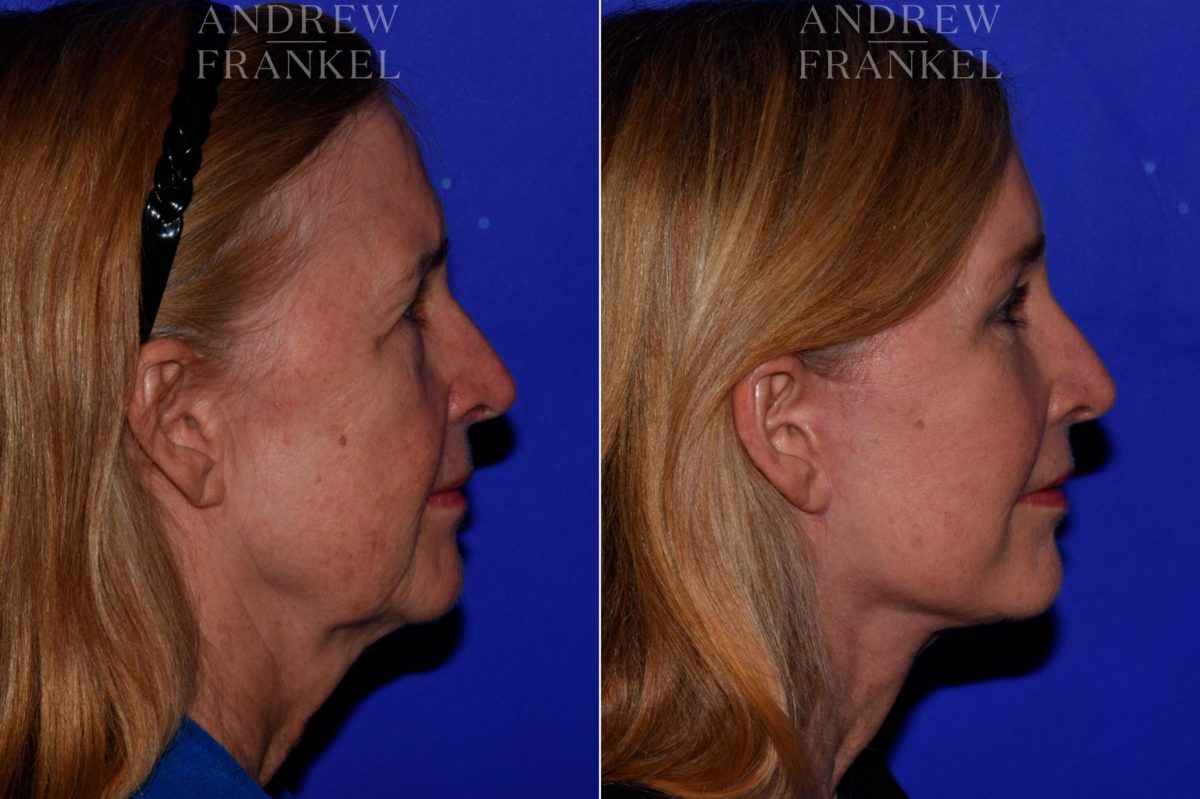 Facial Rejuvenation before and after photos in Beverly Hills, CA, Patient 16836