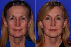 Facial Rejuvenation before and after photos in Beverly Hills, CA, Patient 16836