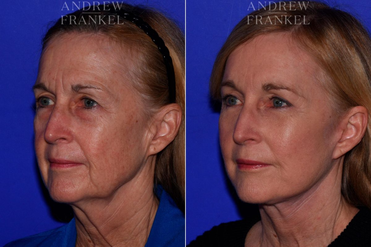 Facial Rejuvenation before and after photos in Beverly Hills, CA, Patient 16836