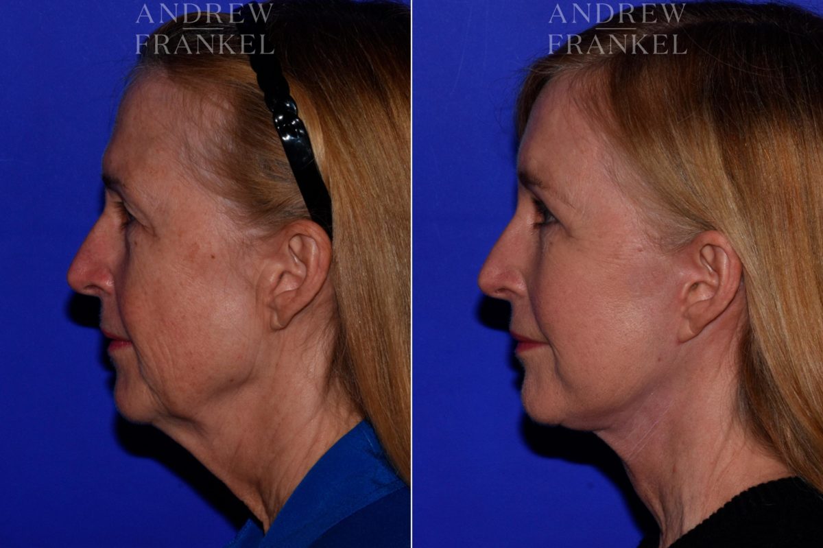 Facial Rejuvenation before and after photos in Beverly Hills, CA, Patient 16836