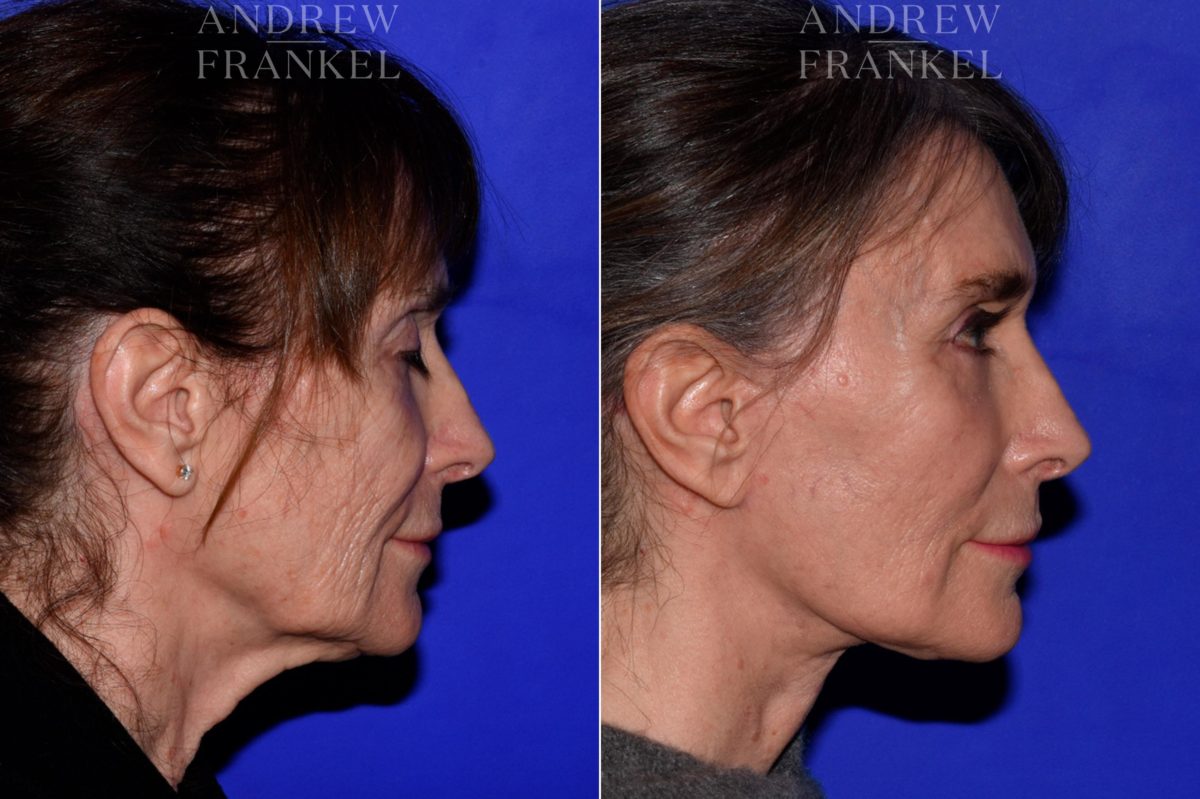 Facelift before and after photos in Beverly Hills, CA, Patient 16819