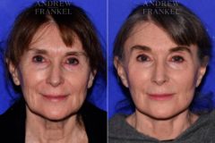 Facelift before and after photos in Beverly Hills, CA, Patient 16819