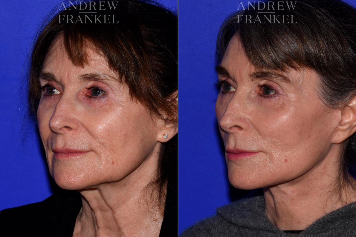 Facelift before and after photos in Beverly Hills, CA, Patient 16819