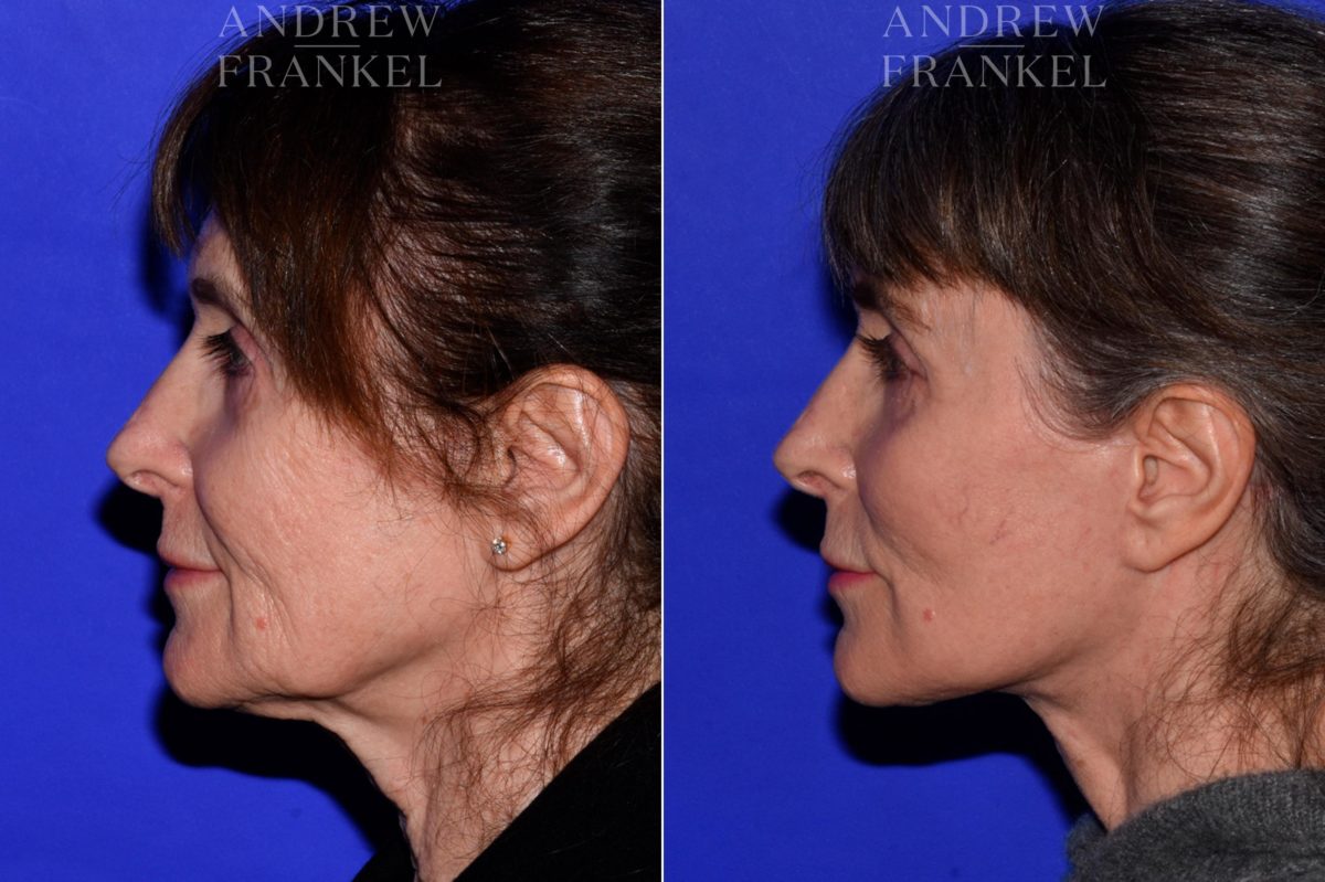 Facelift before and after photos in Beverly Hills, CA, Patient 16819