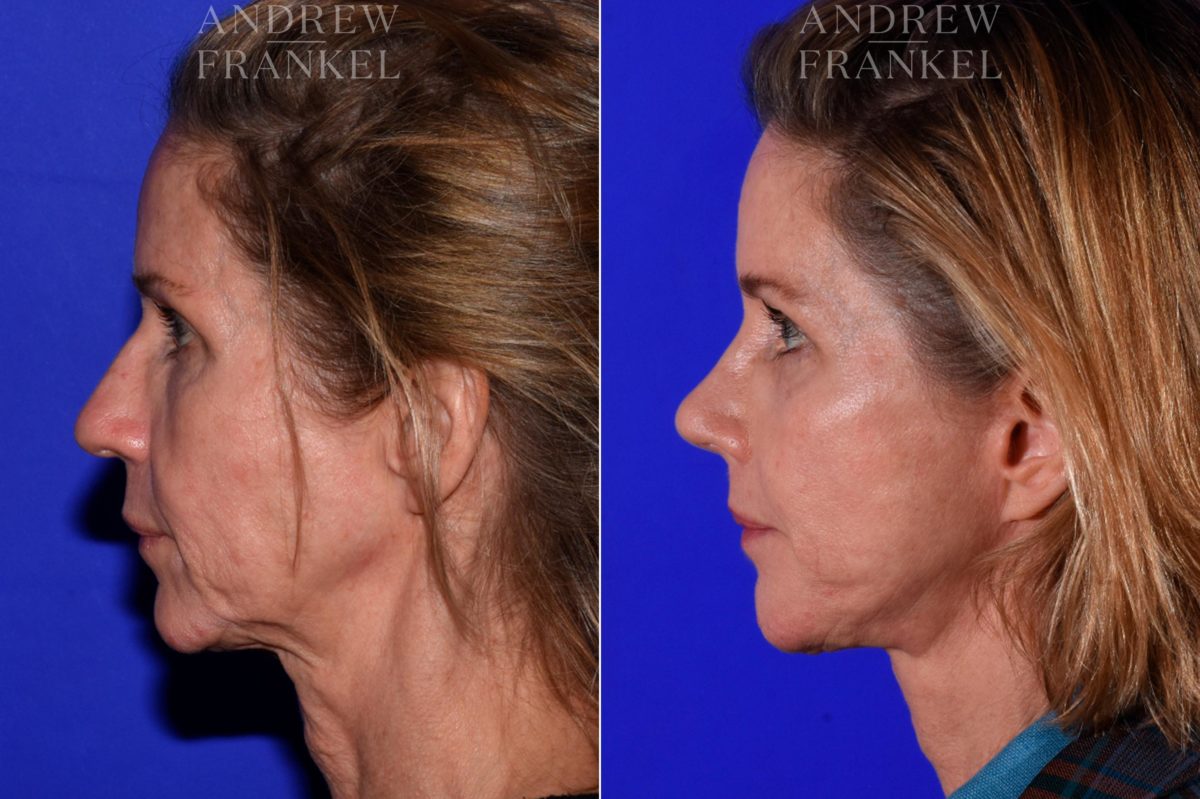 Facial Rejuvenation before and after photos in Beverly Hills, CA, Patient 17162