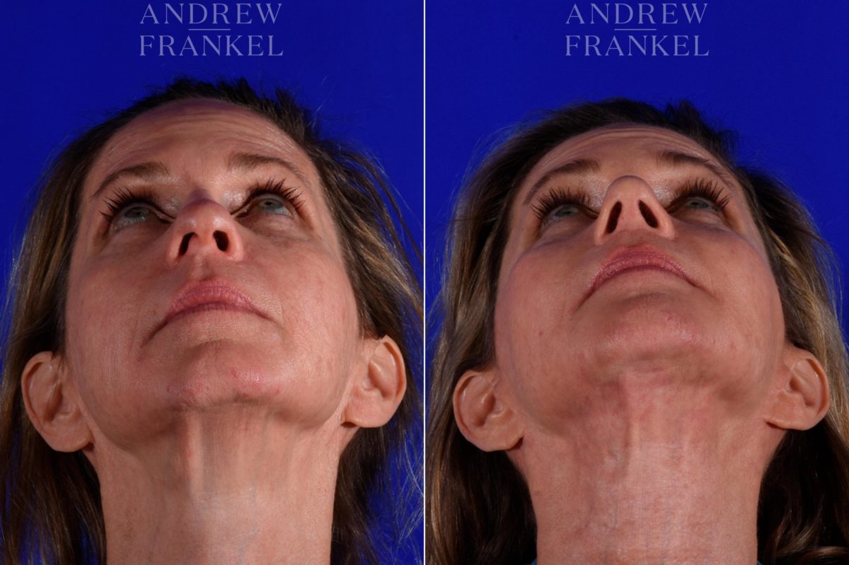Facial Rejuvenation before and after photos in Beverly Hills, CA, Patient 17162