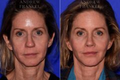 Facial Rejuvenation before and after photos in Beverly Hills, CA, Patient 17162