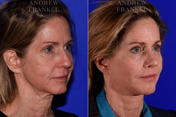 Facial Rejuvenation before and after photos in Beverly Hills, CA, Patient 17162