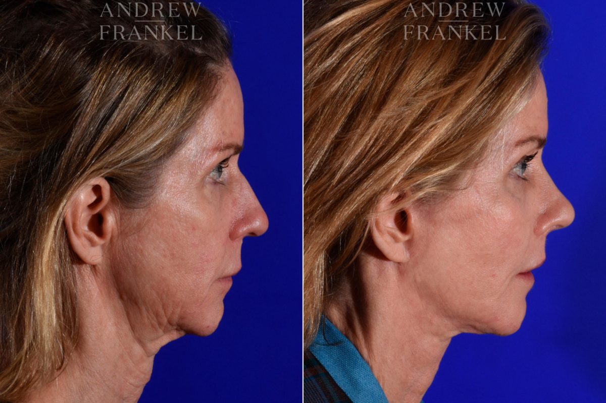 Facial Rejuvenation before and after photos in Beverly Hills, CA, Patient 17162