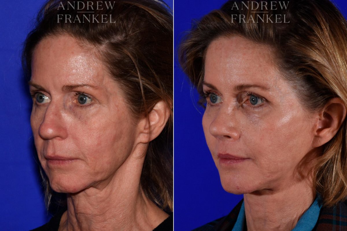 Facial Rejuvenation before and after photos in Beverly Hills, CA, Patient 17162