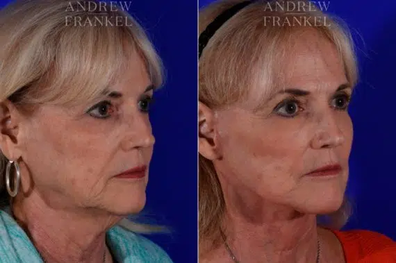 Facelift before and after photos in Beverly Hills, CA, Patient 17187