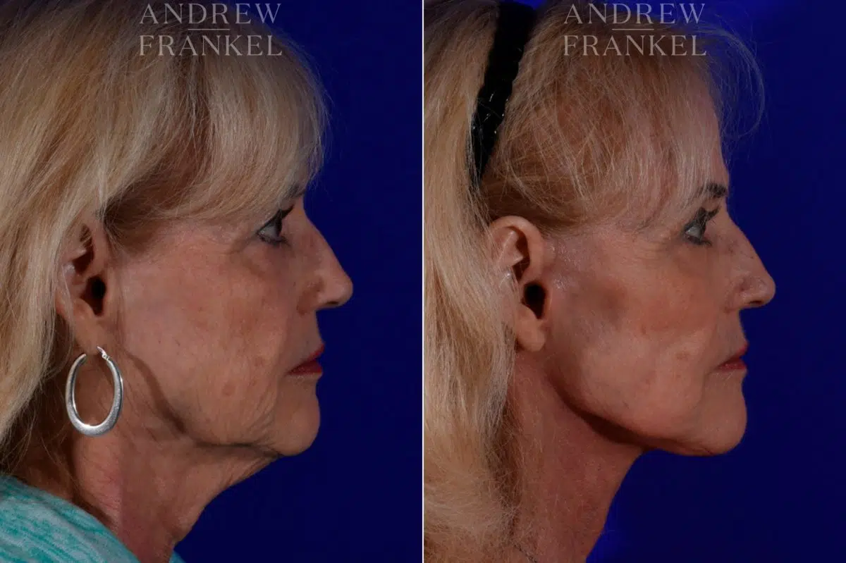 Facelift before and after photos in Beverly Hills, CA, Patient 17187