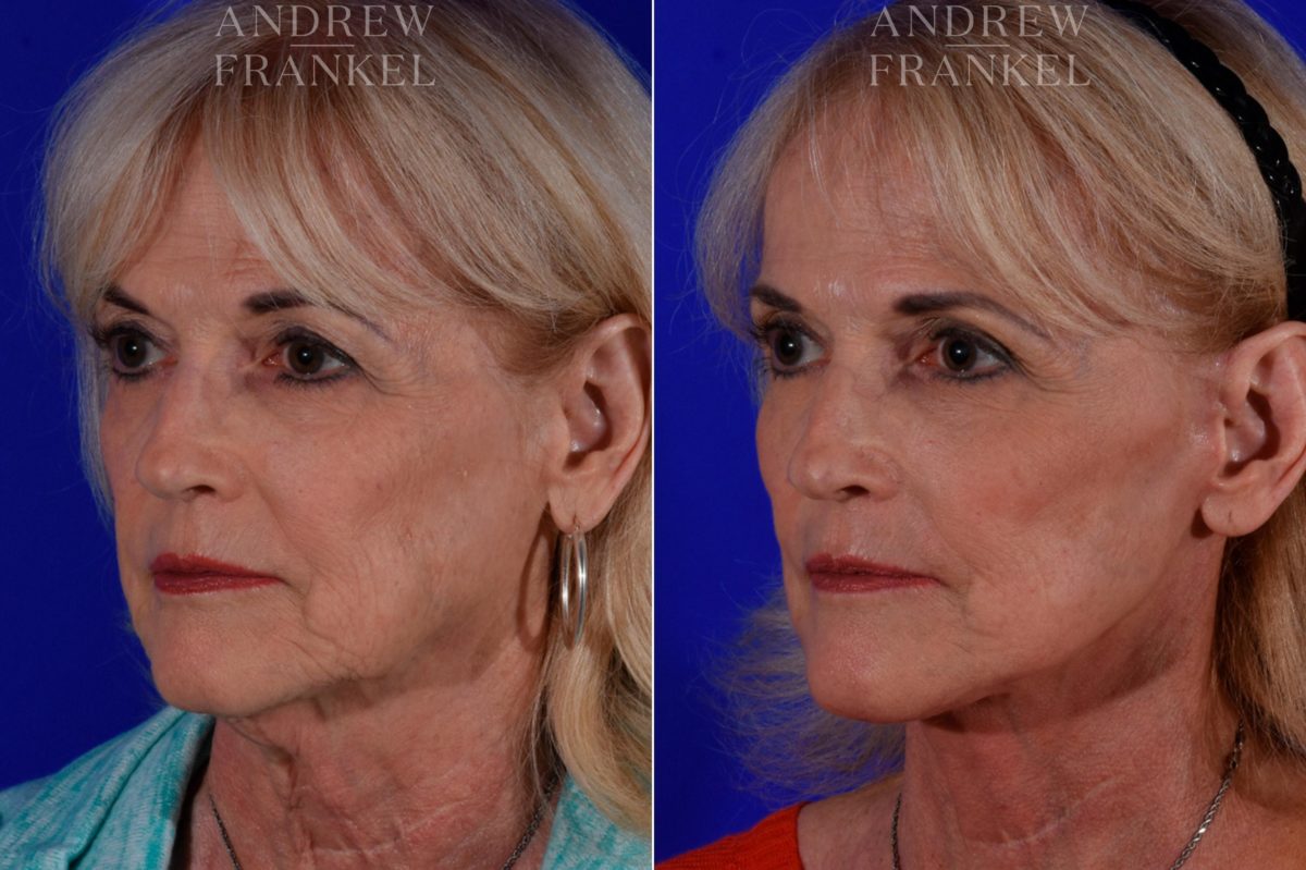 Facelift before and after photos in Beverly Hills, CA, Patient 17187