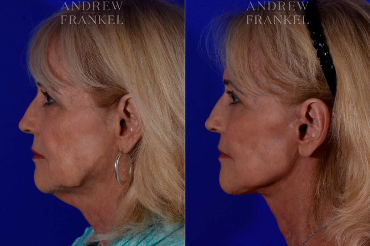 Facelift before and after photos in Beverly Hills, CA, Patient 17187