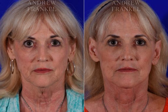 Facelift before and after photos in Beverly Hills, CA, Patient 17187