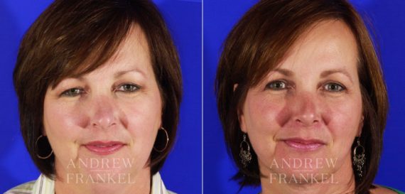 Blepharoplasty before and after photos in Beverly Hills, CA, Patient 3303