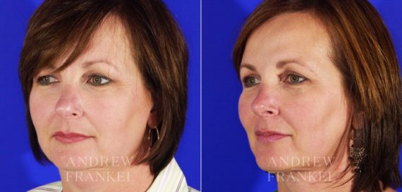 Blepharoplasty before and after photos in Beverly Hills, CA, Patient 3303