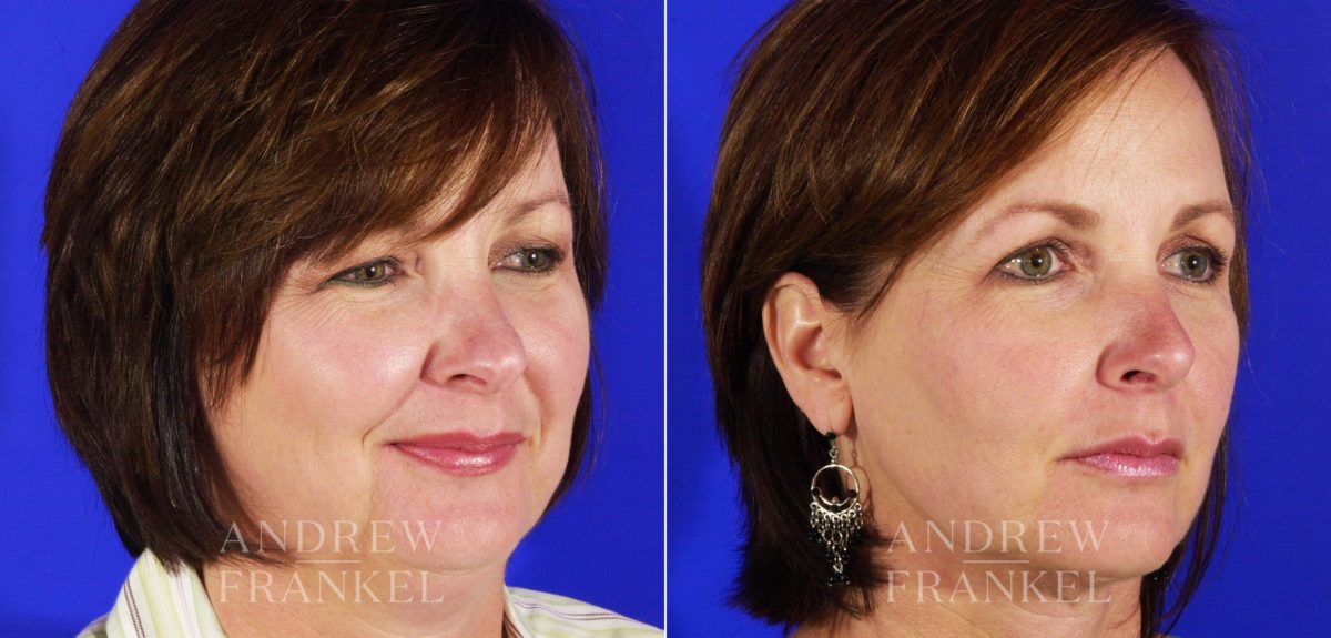 Blepharoplasty before and after photos in Beverly Hills, CA, Patient 3303