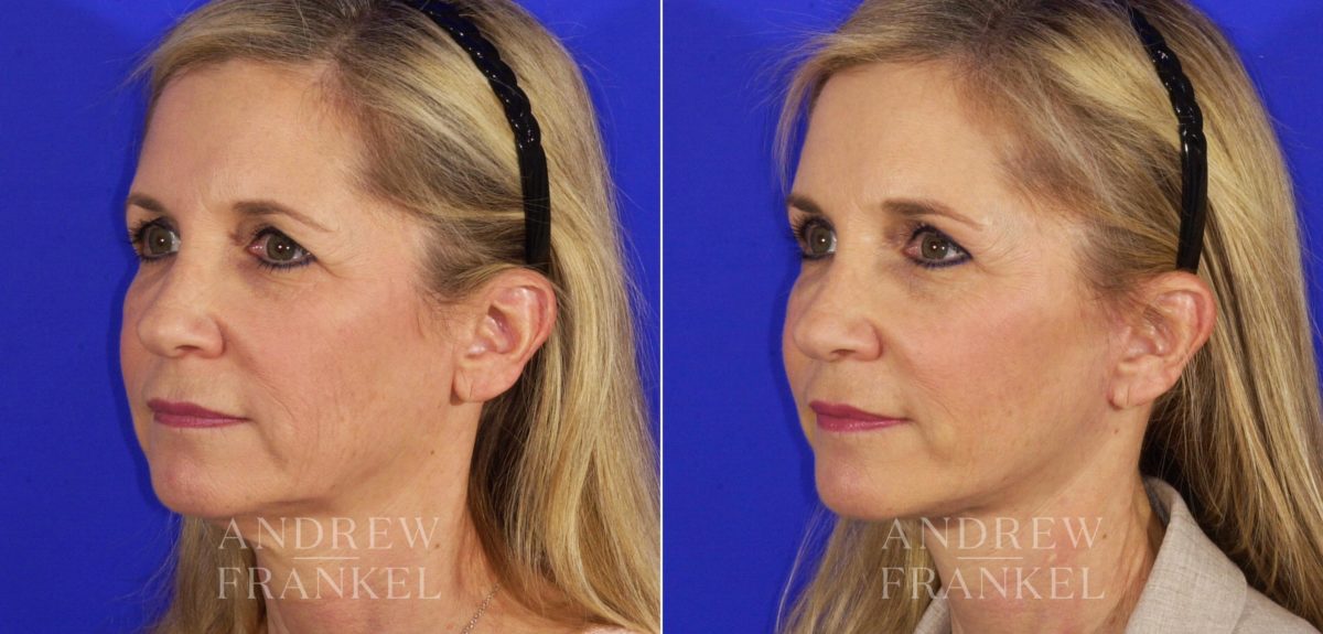 Facelift before and after photos in Beverly Hills, CA, Patient 6700