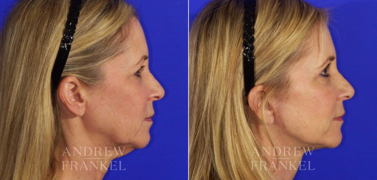 Facelift before and after photos in Beverly Hills, CA, Patient 6700