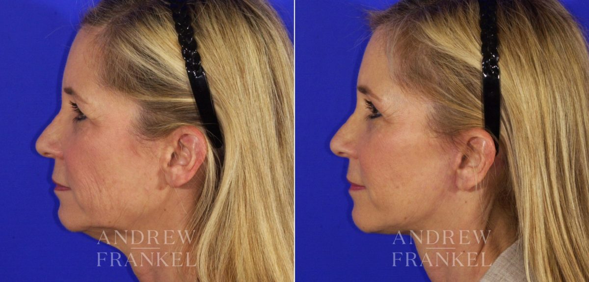Facelift before and after photos in Beverly Hills, CA, Patient 6700