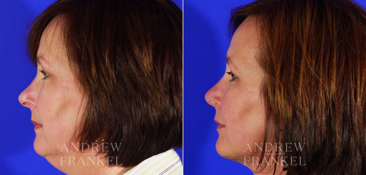 Rhinoplasty before and after photos in Beverly Hills, CA, Patient 5010