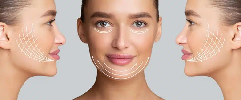 Advantages of Deep Plane Facelift