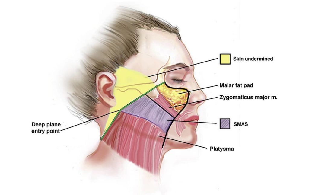 Deep plane facelift incisions