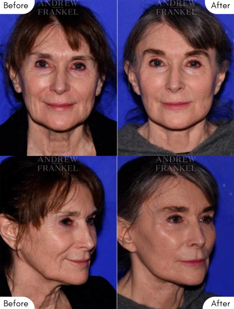 Nasolabial folds - Mid-face lift before and after