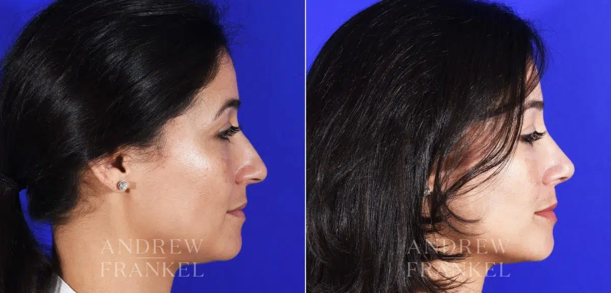 Rhinoplasty before and after photos in Beverly Hills, CA, Patient 11494