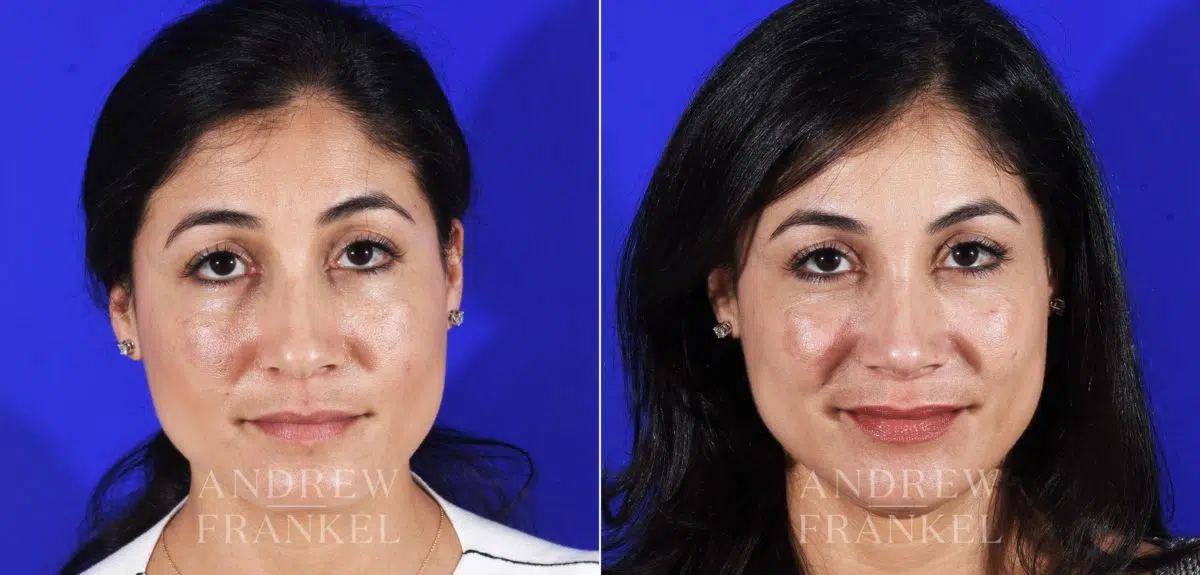 Rhinoplasty before and after photos in Beverly Hills, CA, Patient 11494