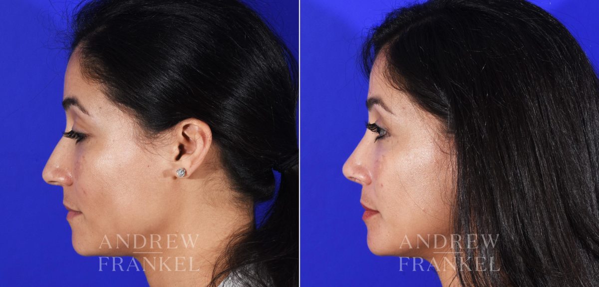 Rhinoplasty before and after photos in Beverly Hills, CA, Patient 11494