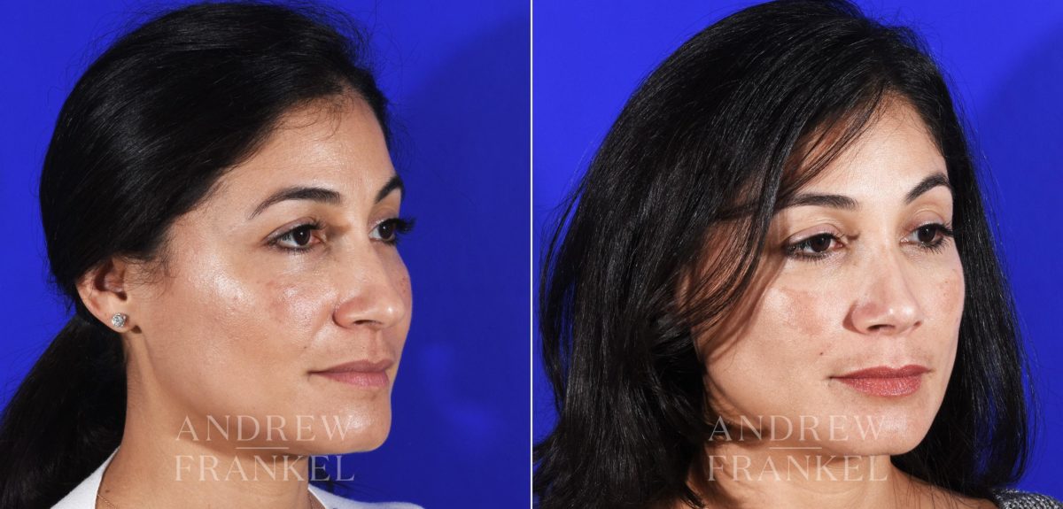 Rhinoplasty before and after photos in Beverly Hills, CA, Patient 11494