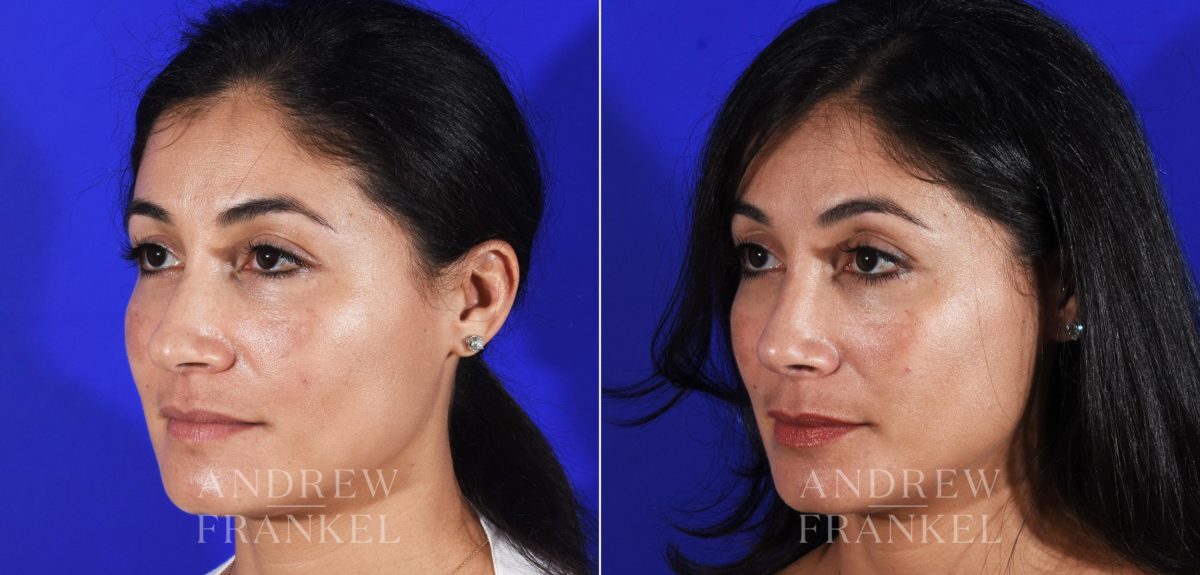 Rhinoplasty before and after photos in Beverly Hills, CA, Patient 11494