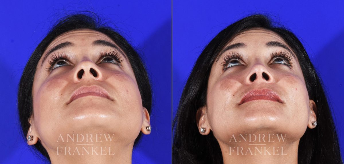 Rhinoplasty before and after photos in Beverly Hills, CA, Patient 11494