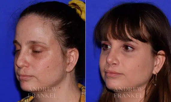 Rhinoplasty before and after photos in Beverly Hills, CA, Patient 17215