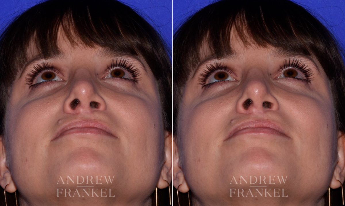 Rhinoplasty before and after photos in Beverly Hills, CA, Patient 17215