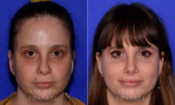 Rhinoplasty before and after photos in Beverly Hills, CA, Patient 17215