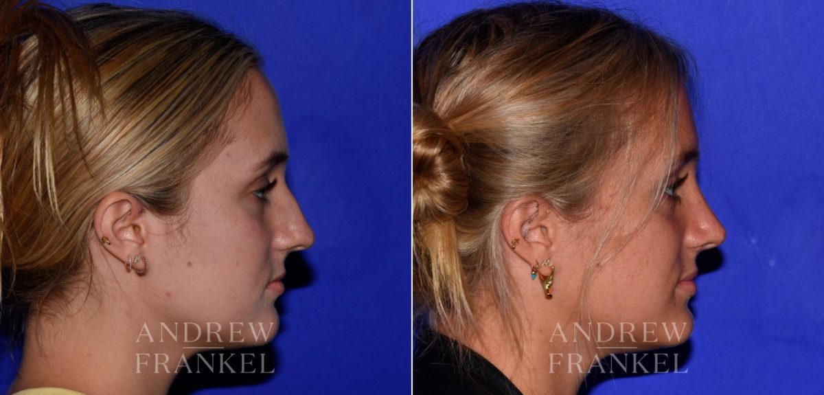 Rhinoplasty before and after photos in Beverly Hills, CA, Patient 17228