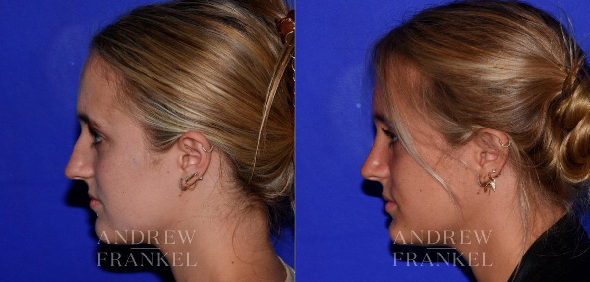 Rhinoplasty before and after photos in Beverly Hills, CA, Patient 17228