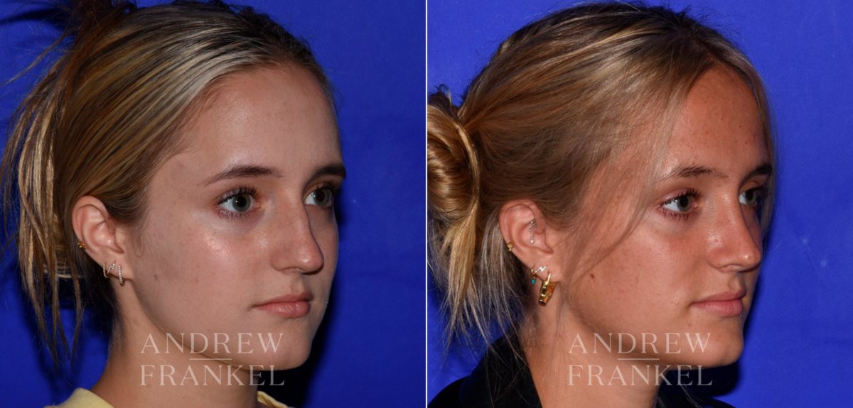 Rhinoplasty before and after photos in Beverly Hills, CA, Patient 17228