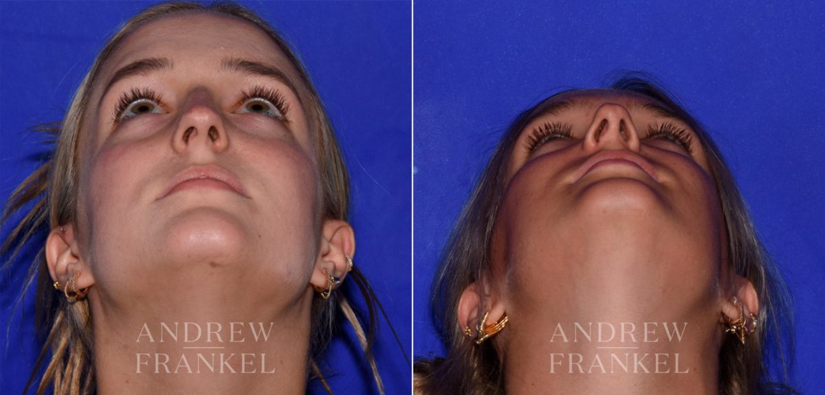 Rhinoplasty before and after photos in Beverly Hills, CA, Patient 17228
